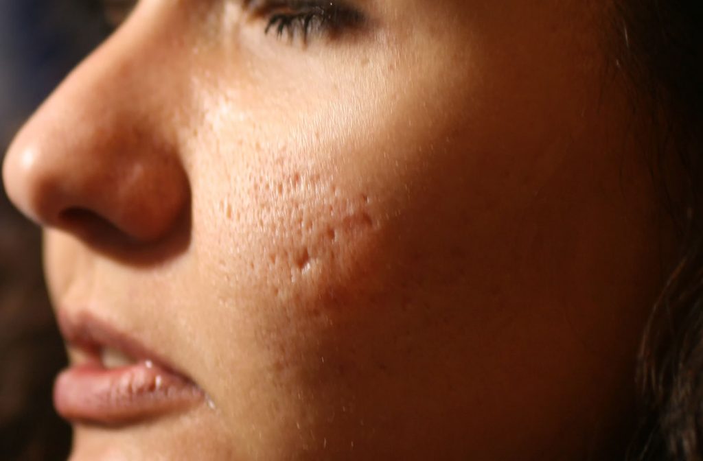 microneedling